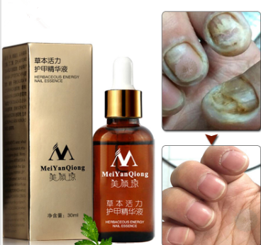 Fungal Nail Treatment Feet Care Essence Nail Foot Whitening Toe Nail Fungus Removal Gel Anti Infection Paronychia Onychomycosis