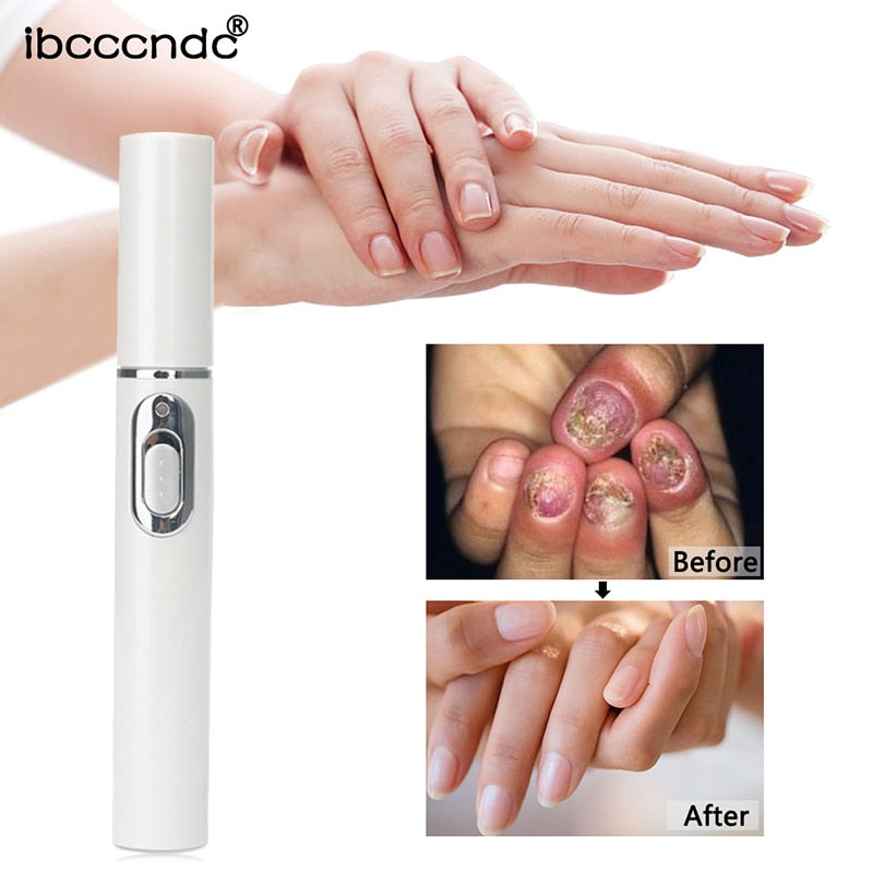 1 Pcs Anti-fungal Home Set Laser Pen Finger Toe Nail Fungus Care Kit