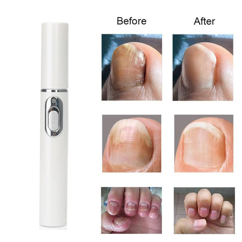 1 Pcs Anti-fungal Home Set Laser Pen Finger Toe Nail Fungus Care Kit